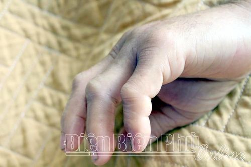Đề phòng bị rắn độc cắn trong mùa hè