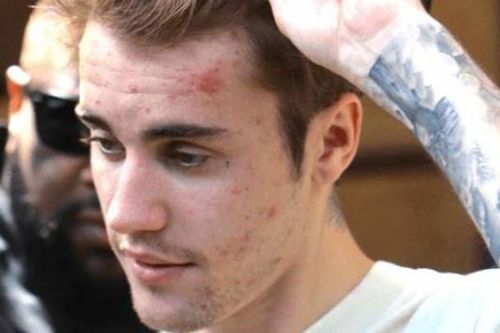 Justin Bieber: 'Tôi bị bệnh ảnh hưởng tới não và da'