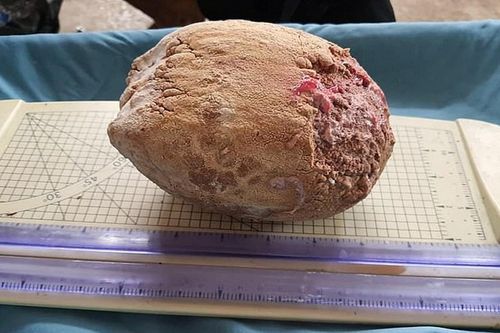 Lấy sỏi mật nặng 1,7 kg từ con voi 50 tuổi ở Thái Lan