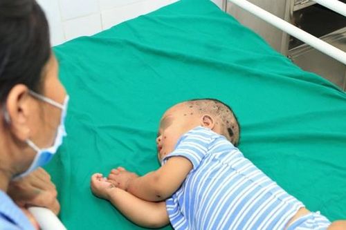 Nghệ An: Nhiều trẻ nhỏ nguy kịch phải cấp cứu do bị ong đốt