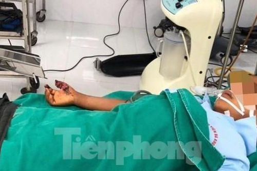 Bé trai 8 tuổi dập nát tay vì nghịch kíp mìn