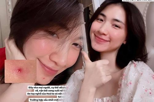 Hòa Minzy review cực có tâm quá trình trị mụn tại gia