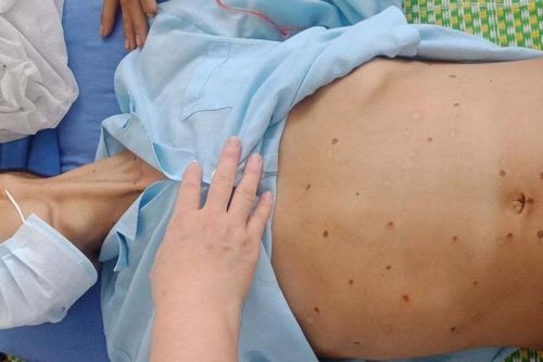 Bụng chướng, lỗ chỗ những vết sẹo sau khi chữa viêm gan tại nhà