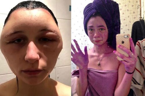 Cười ra nước mắt với loạt tai nạn khó đỡ khi tự nhuộm tóc tại nhà