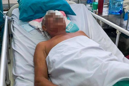 Người đàn ông bị thanh gỗ dài 30 cm găm vào đầu