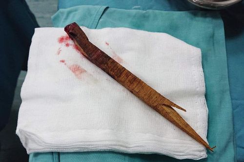 Cứu sống người đàn ông bị thanh gỗ 30cm xuyên qua đầu