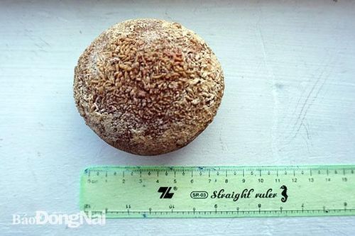 Phẫu thuật lấy viên sỏi 'khủng' phát triển trong bàng quang hơn 20 năm