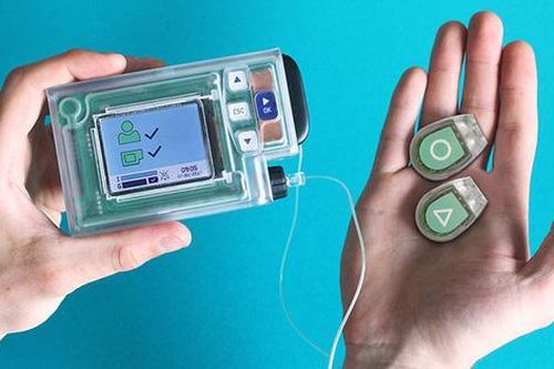 Sắp có tuyến tụy nhân tạo cho bệnh nhân tiểu đường