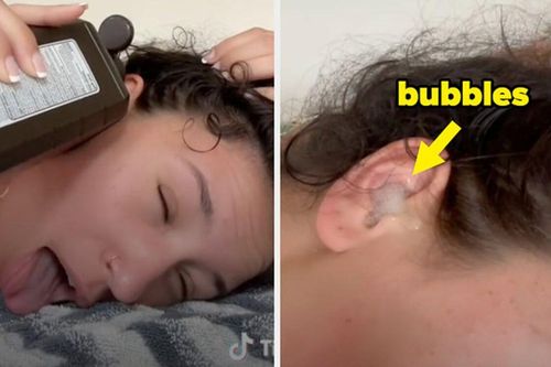 Cảnh báo trào lưu đổ oxy già vào tai trên TikTok