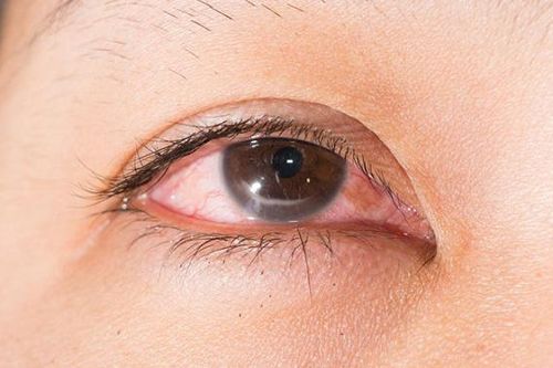 Những điều cần biết về bệnh viêm giác mạc chấm nông