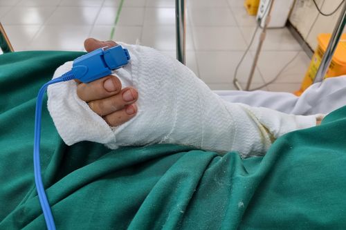 Xuyên đêm nối bàn tay bị đứt lìa cho bệnh nhân ở Bình Dương