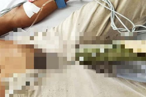 Cọc dừa 60cm đâm xuyên tầng sinh môn lên bụng người đàn ông