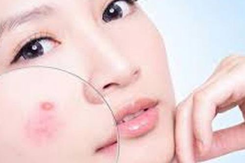 Một số bài thuốc sắc trị mụn trứng cá
