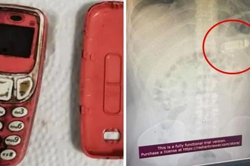 Một bệnh nhân vào viện vì đã nuốt cả chiếc điện thoại Nokia 3310, đến bác sĩ cũng choáng