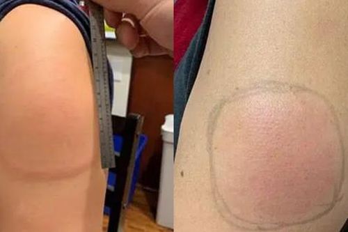 Tại sao nhiều người xuất hiện triệu chứng 'cánh tay COVID' sau khi tiêm vaccine?