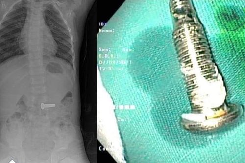 Gắp van xe đạp từ trong bụng bé trai 30 tháng tuổi