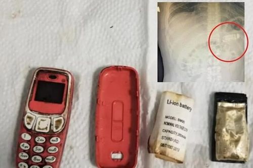 Nuốt chửng 'cục gạch' Nokia vào bụng, gã tù nhân suýt mất mạng