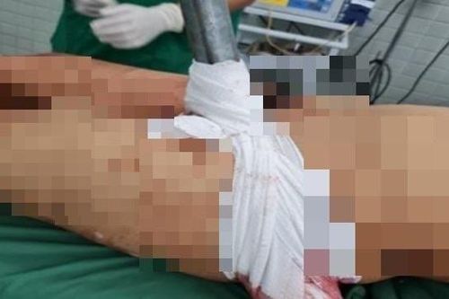 TP HCM: Phẫu thuật cấp cứu nam thanh niên bị ống sắt đâm xuyên đùi