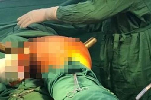 Cấp cứu thành công nam thanh niên bị ống sắt lan can cầu đâm xuyên vùng bẹn