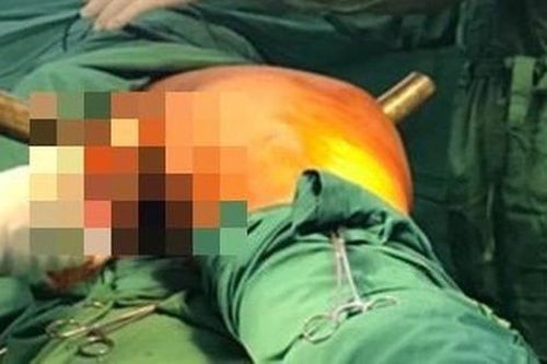 Nam thanh niên 19 tuổi bị ống sắt đâm xuyên vùng bẹn