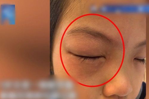 Bé gái bị dị ứng với bài tập Toán, cứ ngồi vào bàn là ngứa ngáy phát khóc, mắt sưng húp lên