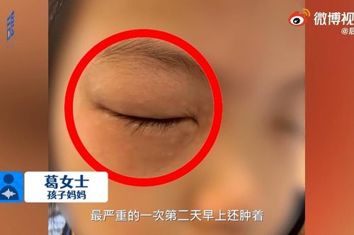 Bé gái mắc chứng bệnh kỳ quái, cứ làm bài tập toán là bị dị ứng