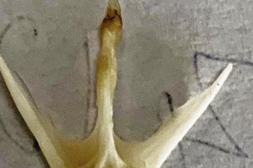 Gắp xương cá 4 chấu đâm sâu vào thành thực quản cho một bệnh nhi