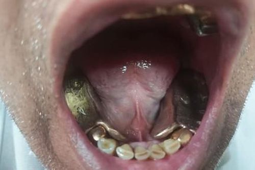 Người đàn ông đúc vàng khối thành răng giả để qua mặt hải quan