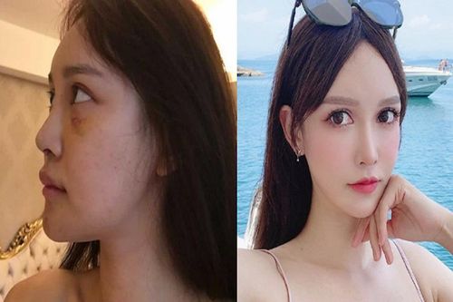 Chi 12 tỷ để 'dao kéo', gái xinh tự tin chụp ảnh 'cam thường'