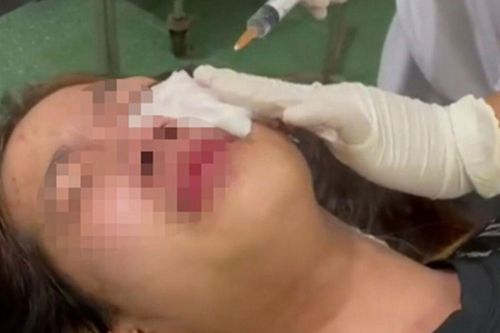 Trêu ghẹo không thành, thanh niên xịt hơi cay vào mắt và hành hung nữ sinh lớp 9