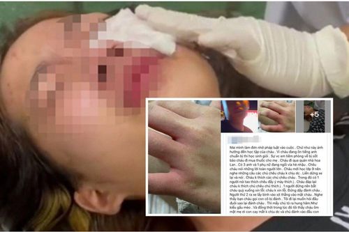 Xót xa lời cầu cứu của người mẹ vụ nữ sinh bị nhóm nam thanh niên hành hung, xịt hơi cay vào mắt