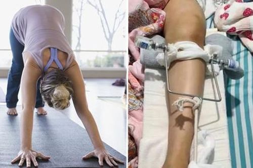Cố 'giúp' tập động tác thật chuẩn, giáo viên yoga ở Trung Quốc làm gãy xương đùi học viên