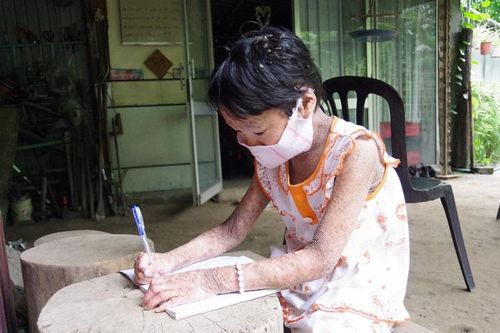 Ước mơ của cô bé 'da rắn'