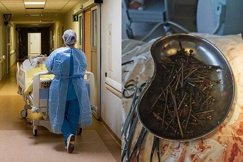 Phát hiện hơn 1kg đinh và vít kim loại trong dạ dày người đàn ông