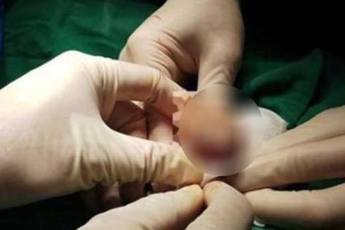 Nam giới có vấn đề này ở 'cậu nhỏ', 90% nguy cơ ung thư