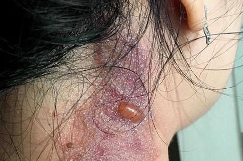 Cảnh báo hiểm họa kiến ba khoang 'tấn công' người trong mùa mưa