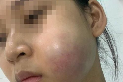 Bỏ tiền triệu 'nâng cấp sắc đẹp', thiếu nữ 'nhận' về gương mặt biến dạng