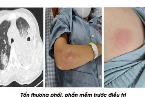 Nữ bệnh nhân nhiễm vi khuẩn Whitmore áp xe nặng, suy kiệt