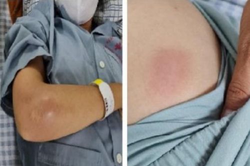 Cô gái sưng đau 'vòng một' đi cấp cứu tại bệnh viện được phát hiện bị 'vi khuẩn ăn thịt người' tấn công