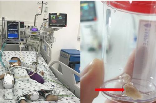 Bé trai nguy kịch vì mảnh xương trong nước hầm nấu cháo găm vào phế quản