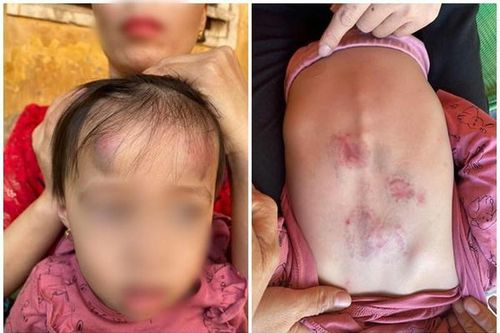 Bé 2 tuổi Bắc Giang bị bạn cùng lớp đấm, đạp bầm dập khi không có giáo viên trong lớp