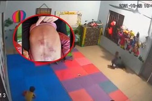 Đình chỉ cơ sở mầm non để cháu bé 22 tháng tuổi bị đánh tím người