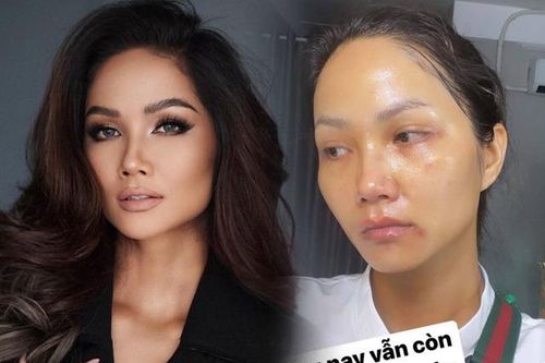 H'Hen Niê xuất hiện với gương mặt bầm dập, skincare kiểu gì mà hỏng luôn mặt tiền