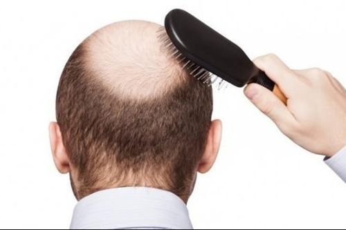 Phát hiện nguyên nhân gây ra chứng hói đầu