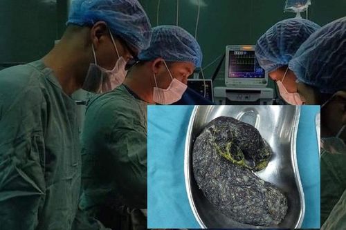 Kỳ lạ hội chứng 'nghiện ăn tóc' và cảnh báo từ bác sĩ