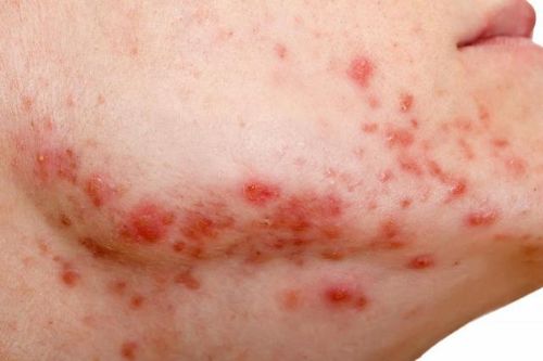 Đời sống Mụn nội tiết là gì? Có thể điều trị được hay không?