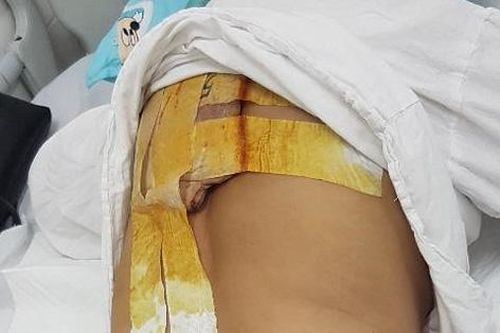 Bị biến chứng do y tế tư nhân chỉ định tiêm không đúng