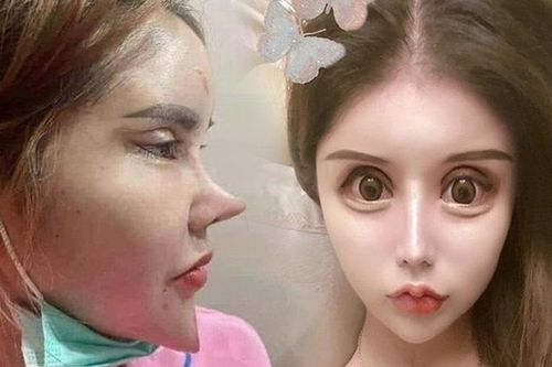 Người phụ nữ trẻ gây hoang mang vì phẫu thuật thẩm mỹ quá đà