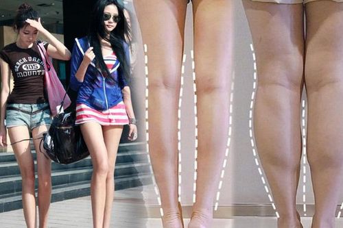 Cắt dây thần kinh để chân thon gọn - xu hướng làm đẹp nguy hiểm