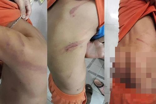 Cháu bé lớp 1 bị cha ruột bạo hành vì học hành không tiến bộ